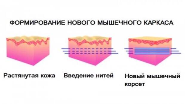 Преимущества нитевого лифтинга влагалища. Перинеовагинальный лифтинг 03