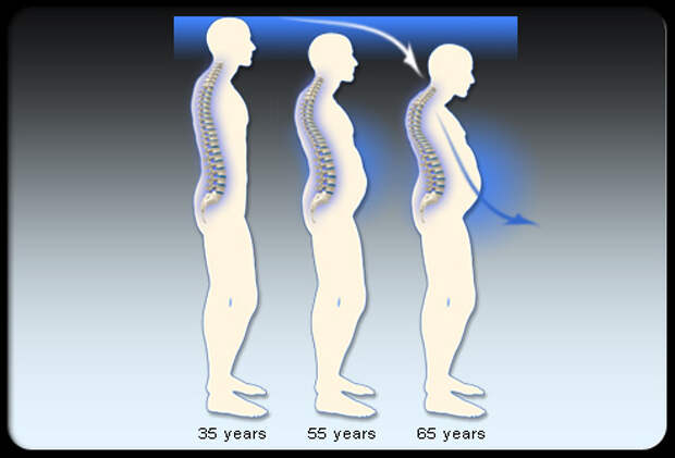 Возраст кости. Возрастные изменения позвоночника. Изменение осанки с возрастом. Позвоночник в старости. Изменение позвоночника с возрастом.