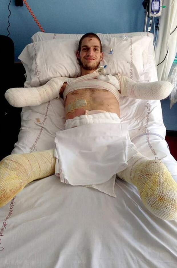 24-летний спортсмен лишился рук и ног из-за врачебной ошибки