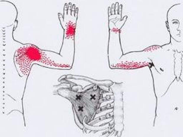 Карта отраженной боли триггерных точек