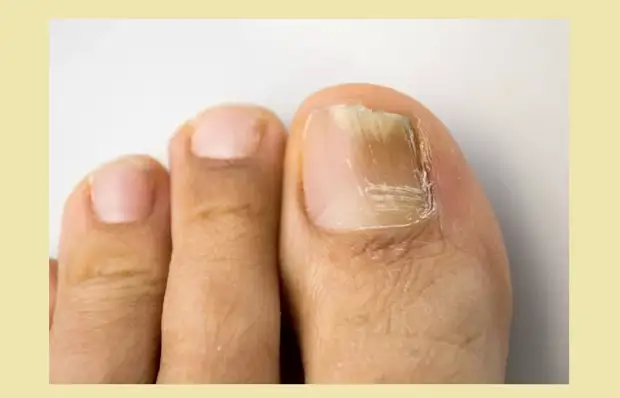 Заболевание ногтей на пальцах ног