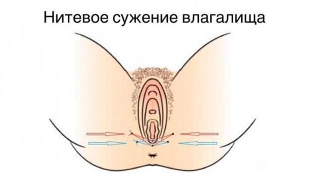 Преимущества нитевого лифтинга влагалища. Перинеовагинальный лифтинг 02