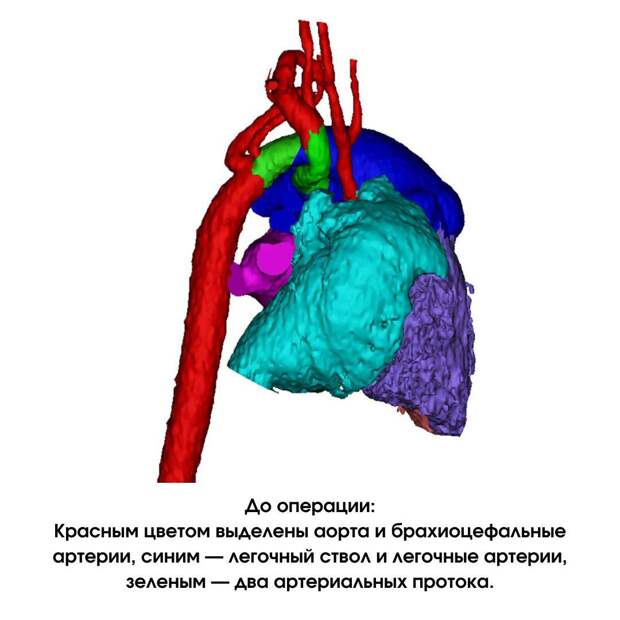 Критическую патологию развития плода у жительницы Марий Эл обнаружили на 23-й неделе беременности. УЗИ показало, что сердце ребенка развивается со множественными аномалиями. Прогнозы были крайне неблагоприятные, чреватые процедурой прерывания беременности, сообщили «Медицинской России». Семья обратилась в НМИЦ им. Е. Н. Мешалкина. Специалисты решились оперировать ребенка и сразу после рождения в Новосибирском перинатальном центре его перевели в Центр и обследовали. Были выявлены: