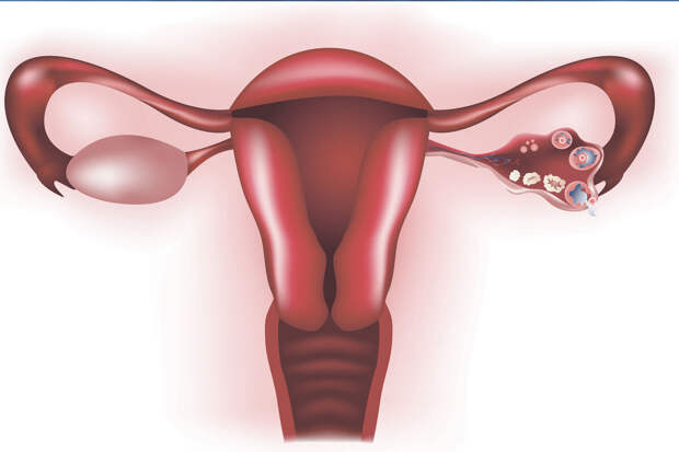 В Первом МГМУ предложили алкоголизировать кисты в яичниках вместо удаления