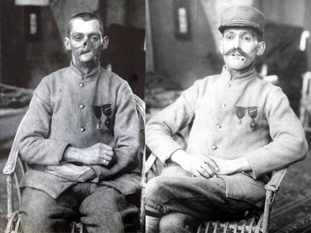 Как женщина спасала жизни ветеранов Первой мировой войны, «восстанавливая» их лица
