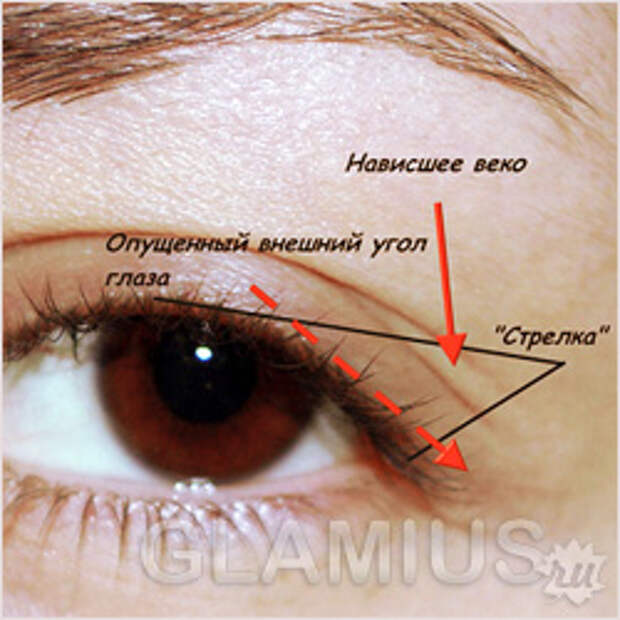 Коррекция формы глаз