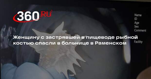 Женщину с застрявшей в пищеводе рыбной костью спасли в больнице в Раменском