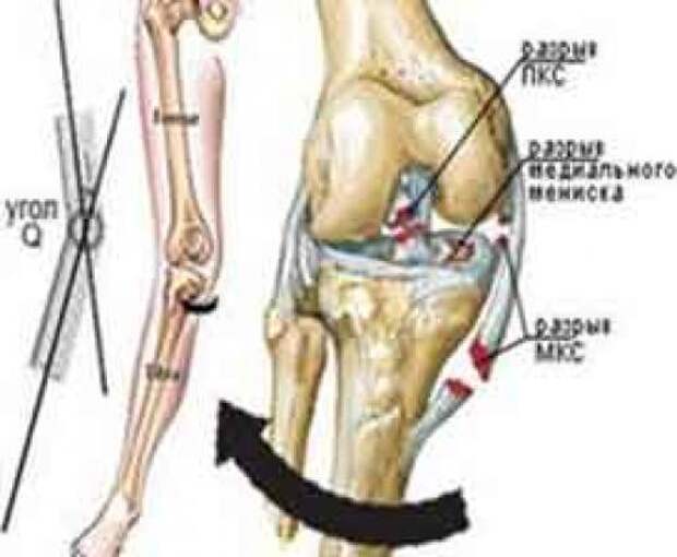 Травма коленного сустава код