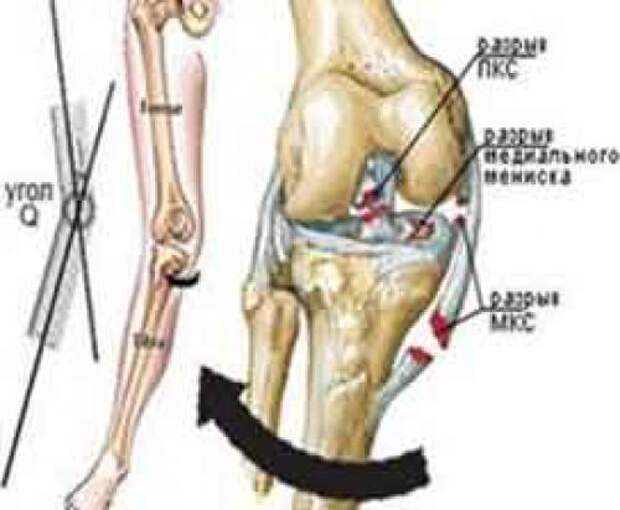 Крестообразная связка коленного сустава разрыв. Травмы колена механизм. Мкб разрыв передней крестообразной связки коленного сустава. Разрыв передней крестообразной связки коленного сустава код мкб. Повреждение крестообразной связки колена мкб 10.