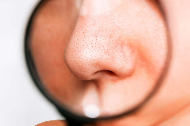 Врач Соколова: агрессивное высушивание кожи провоцирует появление черных точек