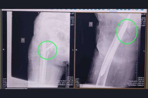 Новосибирские хирурги спасли долгожительницу с переломом шейки бедра