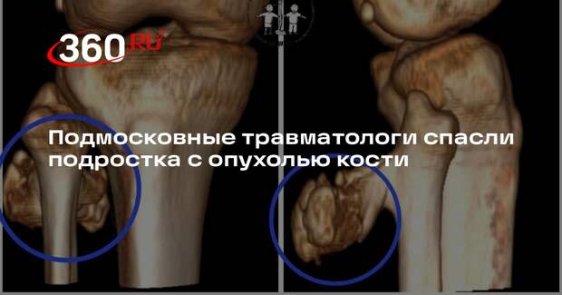 Подмосковные травматологи спасли подростка с опухолью кости
