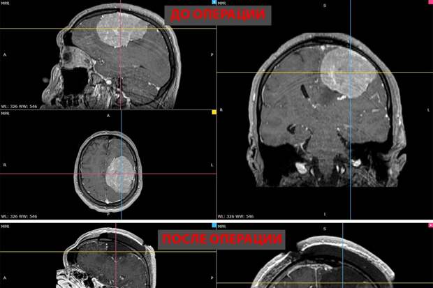В Новосибирске врачи удалили мужчине гигантскую опухоль мозга