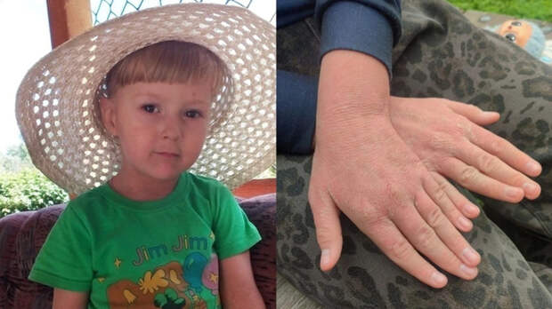 "Дети не хотели с ней играть". Как под Новосибирском живет девочка с "рыбьей кожей"