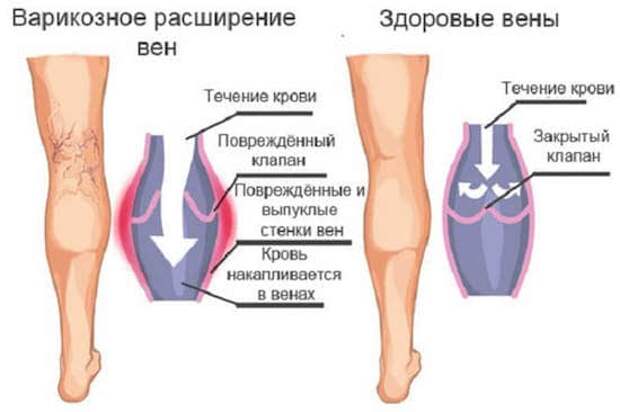 Варикоз: эффективные народные методы лечения2