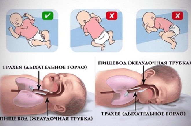 В этом положении нельзя спать младенцам так как это может привести к трагедии