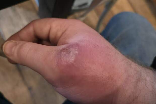 Рука британца превратилась в боксерскую перчатку после укуса паука