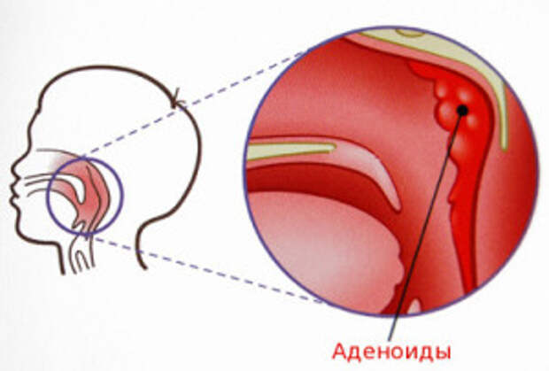 аденоиды лечение народными средствами