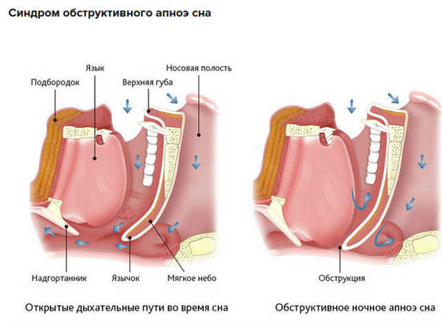 апноэ6 (640x472, 136Kb)