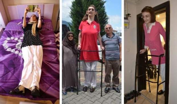 Самая высокая женщина в мире живет в Турции
