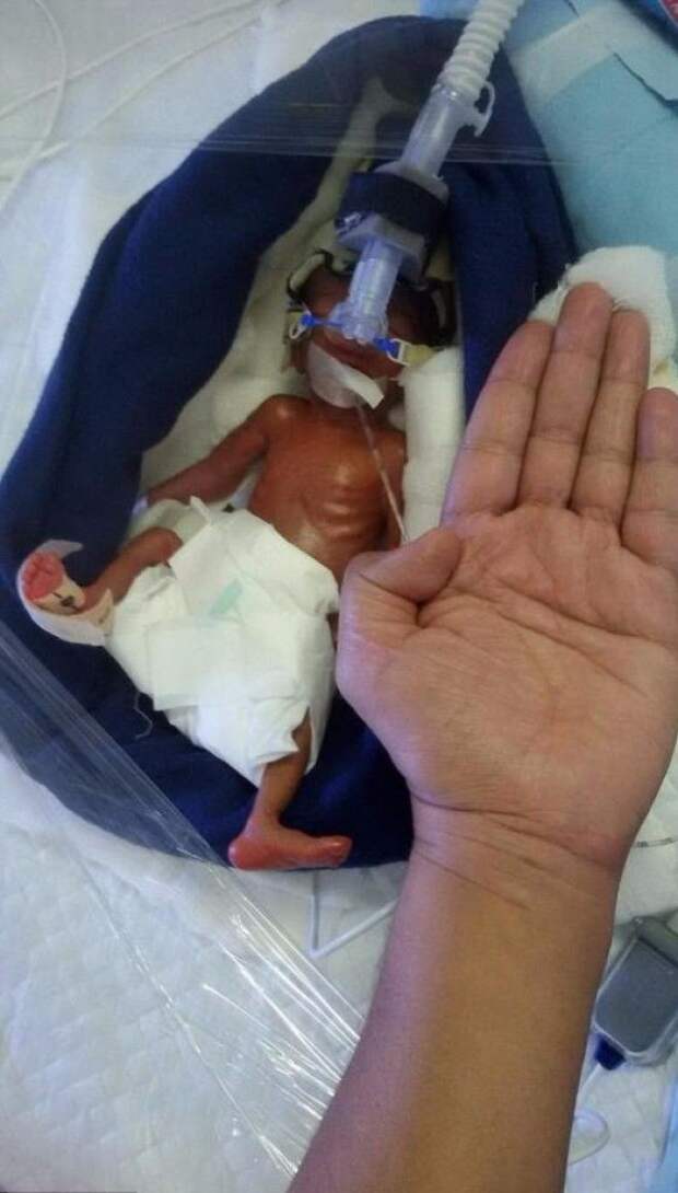 Это один из самых крошечных выживших новорожденных
