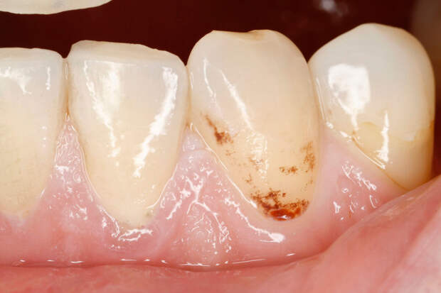 NPJ: устранение бактериального "шума" во рту помогает предотвратить кариес