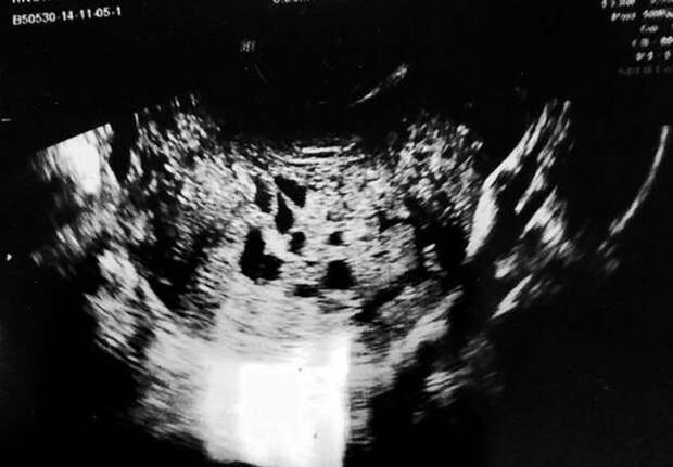 Врачи провели двоёное сканирование живота Лорен, чтобы точно подтвердить диагноз Лорен Ноулз, беременность, врачи, дети, опухоль, рак