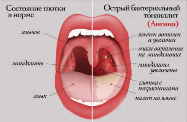 Летняя ангина: как быстро вылечиться в жару  без антибиотиков и восстановиться. Эффективно и безвредно