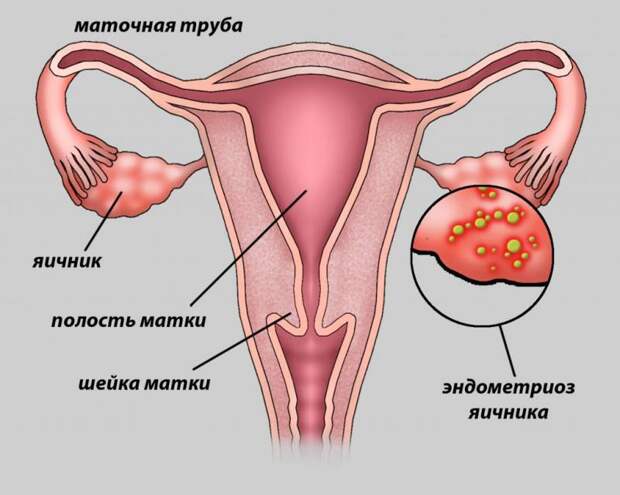 Выделения при эндометриозе: виды и характеристика