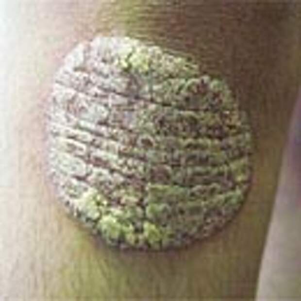 Plaque Psoriasis Pictures: 4