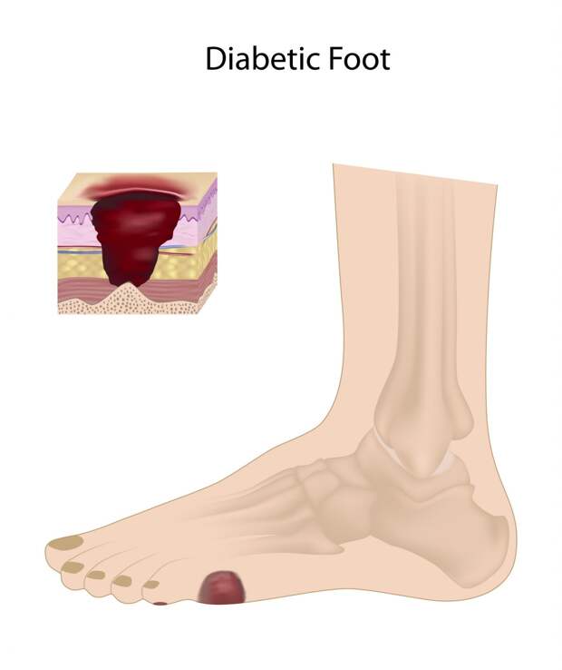 diabetic food illustration