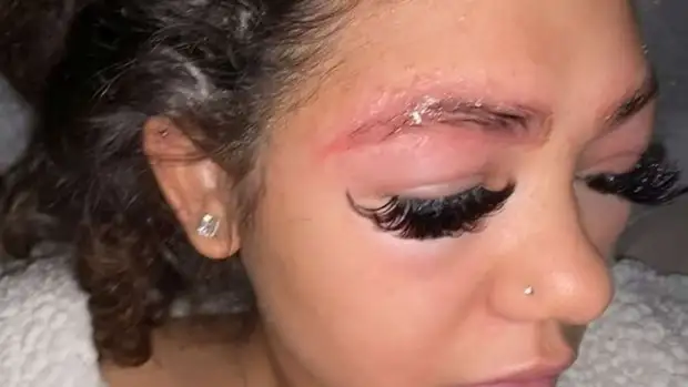 У студентки выпали брови после того, как она их покрасила