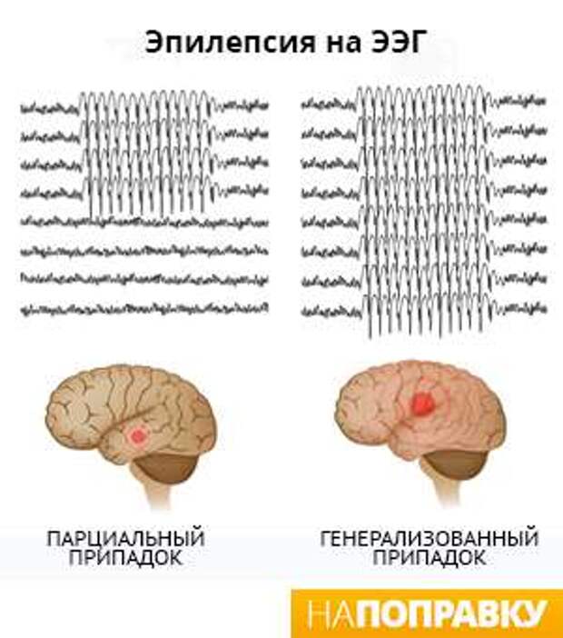 Ээг показывает эпилепсию. ЭЭГ В норме и при эпилепсии. ЭЭГ здорового человека и эпилептика. ЭЭГ при фокальной эпилепсии. Эпилептический признак на ЭЭГ.