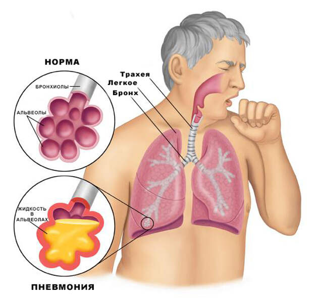 pneumonia_anatomy_pi