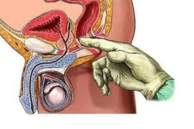 Массаж предстательной железы на инфографике