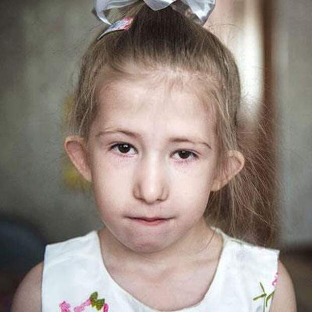 Соня Молтусова, 5 лет, тяжелый врожденный порок сердца, спасет операция, 347 540 ₽