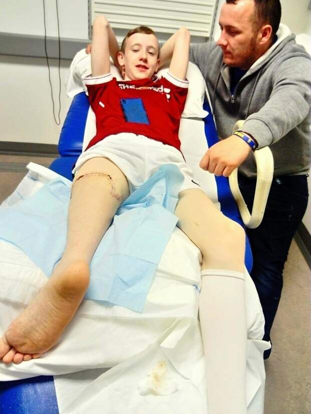 Хирурги пришили ребенку ногу задом наперед, чтобы он мог играть в футбол в мире, люди, нога, спорт, футбол, хирург