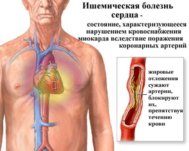 Ишемия сердца и ее лечение народными средствами, ишемия народная медицина. 