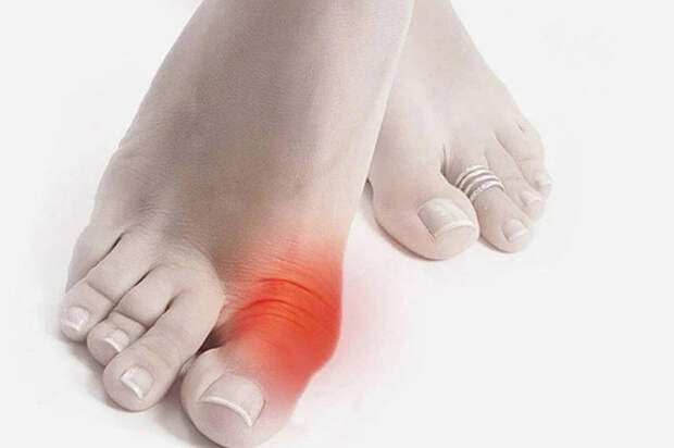 ПОДАГРА - СИЛЬНАЯ БОЛЬ СУСТАВОВ