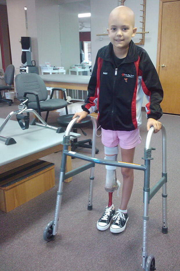 Балерина без ноги: 15 летняя девушка победила рак на пути к своей мечте