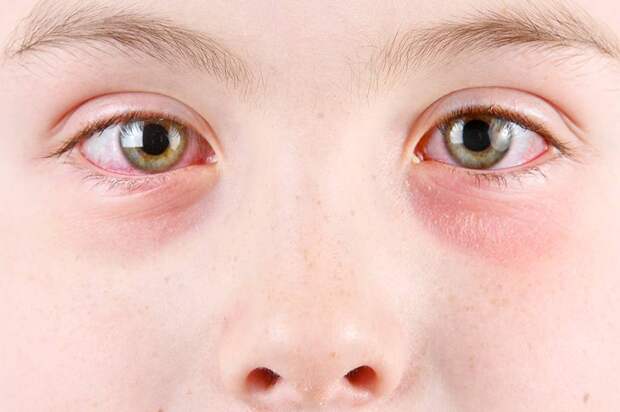 Почему могут возникать темные круги под глазами у детей: педиатр назвала основные причины