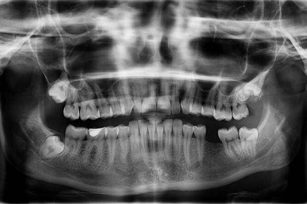 Почему зубы не&nbsp;считаются костью
