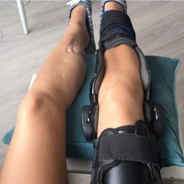 Врачи сказали девушке, что она больше не сможет ходить, но она доказала им обратное авария, девушка, ноги
