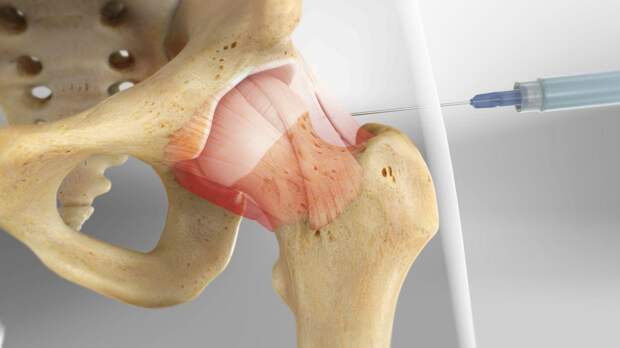 Лечение тазобедренного сустава без операции