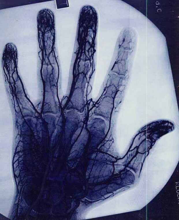 Ангиограмма показывает поврежденные сосуды указательного пальца мастера по йо-йо. 