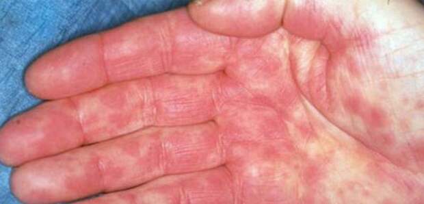 Болячки на руках: фото, симптомы, диагностика и лечение