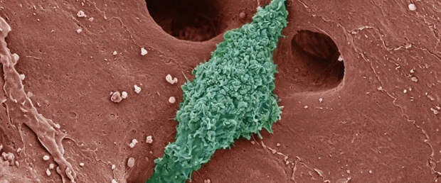 По макрофагам можно оценить, насколько быстро прогрессирует ожирение печени