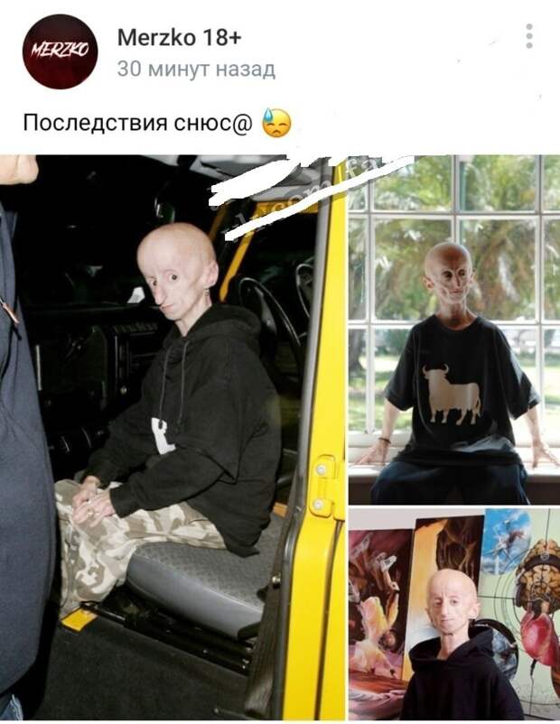 Это художник и музыкант Леон Бота и у него редкая болезнь прогерия и никакого снюса Это художник и музыкант Леон Бота и у него редкая болезнь прогерия и никакого снюса