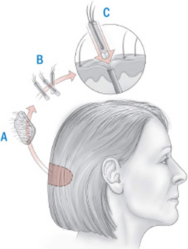 Illustration of hair transplant procedure