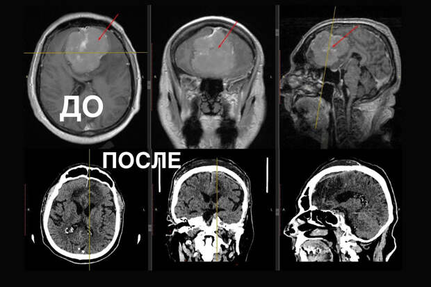 Россиянин упал на улице и узнал об опухоли размером с теннисный мяч у себя в мозге